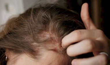 ينتشر بين طلاب المدارس.. أعراض فطريات الرأس