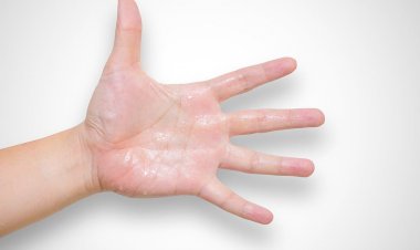 تقرير حول علاج التعرق الزائد في اليدين والقدمين