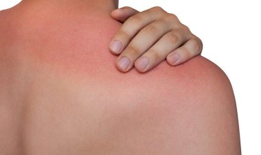 حروق الشمس.. خطر خفي تحت وهج الجمال