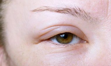 طرق فعّالة للتخلّص من انتفاخ العين بعد البكاء.. دليل منزلي بسيط