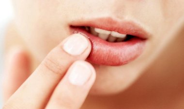 دليل شامل للتخلص من تشقق الشفاه بطرق طبيعية وآمنة