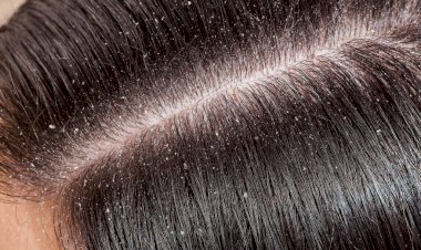 القشرة الدهنية: مشكلة مزعجة وحلول فعّالة لاستعادة صحة فروة الرأس