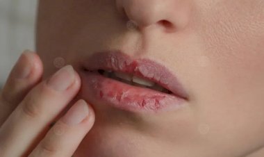 تشقق الشفاه.. الأسباب وطرق العلاج والوقاية