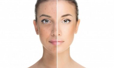 طرق طبيعية فعالة للتخلص من البقع الداكنة وتوحيد لون البشرة