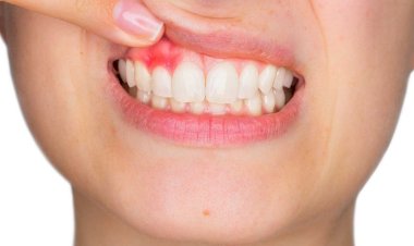 ماذا تنذر تغيرات الفم.. أعراض مبكرة تكشف إصابتك بأمراض مزمنة