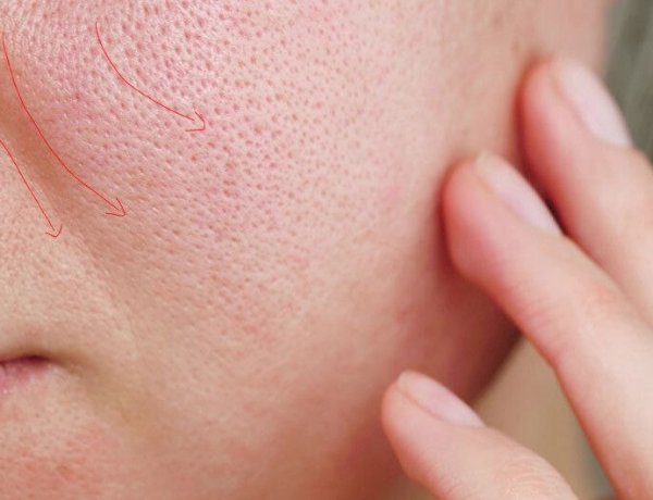 وصفات طبيعية لعلاج مشكلة المسام الواسعة بخطوات سهلة وفعالة للحصول على بشرة أنعم