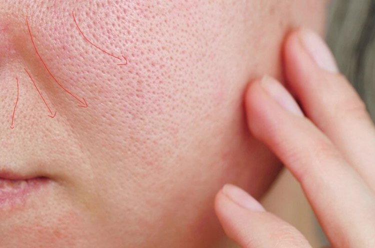 وصفات طبيعية لعلاج مشكلة المسام الواسعة بخطوات سهلة وفعالة للحصول على بشرة أنعم