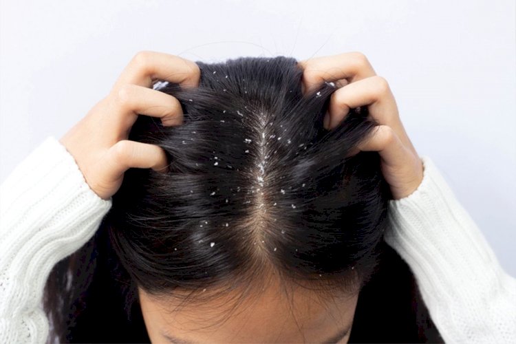 بينها الزيوت العطرية.. 5 زيوت للشعر تزيد قشرة الرأس وتضر الفروة